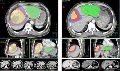 A Prospective Study of Liver Regeneration After Radiotherapy Based on a New (Su’S) Target Area Delineation